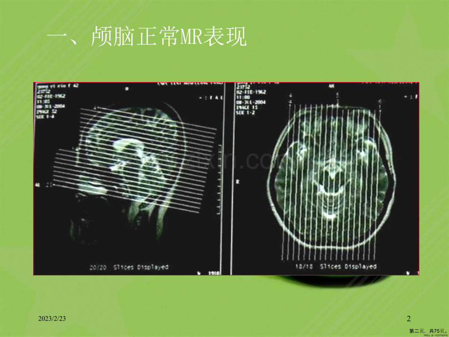 磁共振成像诊断(MRI)脑部疾病(0001).ppt_第2页