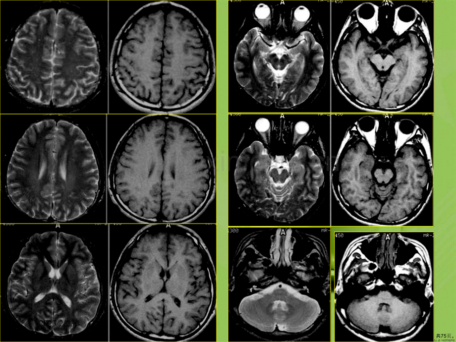 磁共振成像诊断(MRI)脑部疾病(0001).ppt_第3页