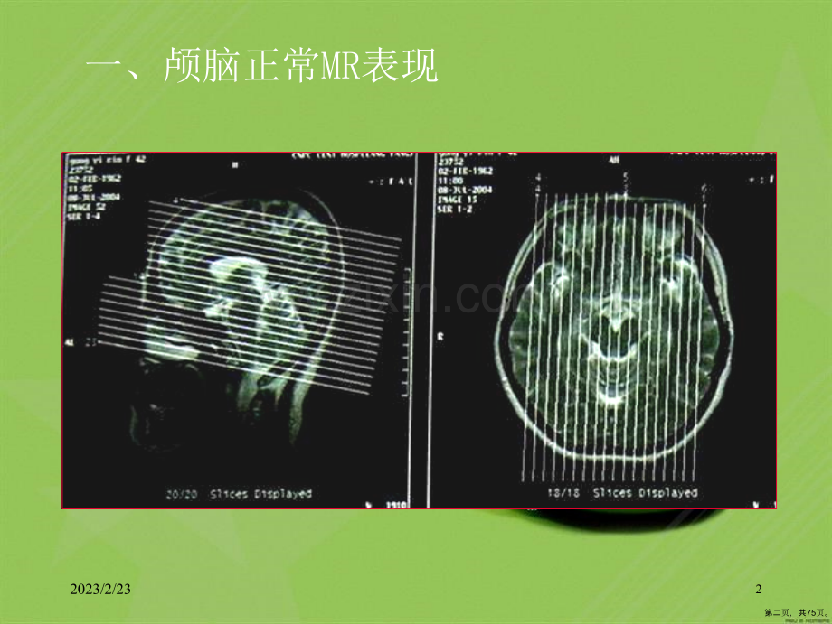 磁共振成像诊断(MRI)脑部疾病(0002).ppt_第2页