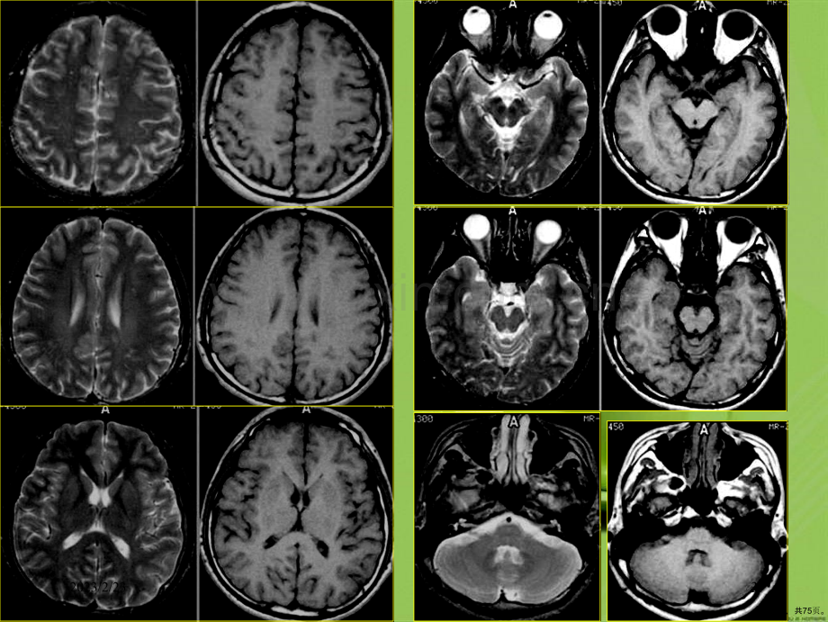 磁共振成像诊断(MRI)脑部疾病(0002).ppt_第3页