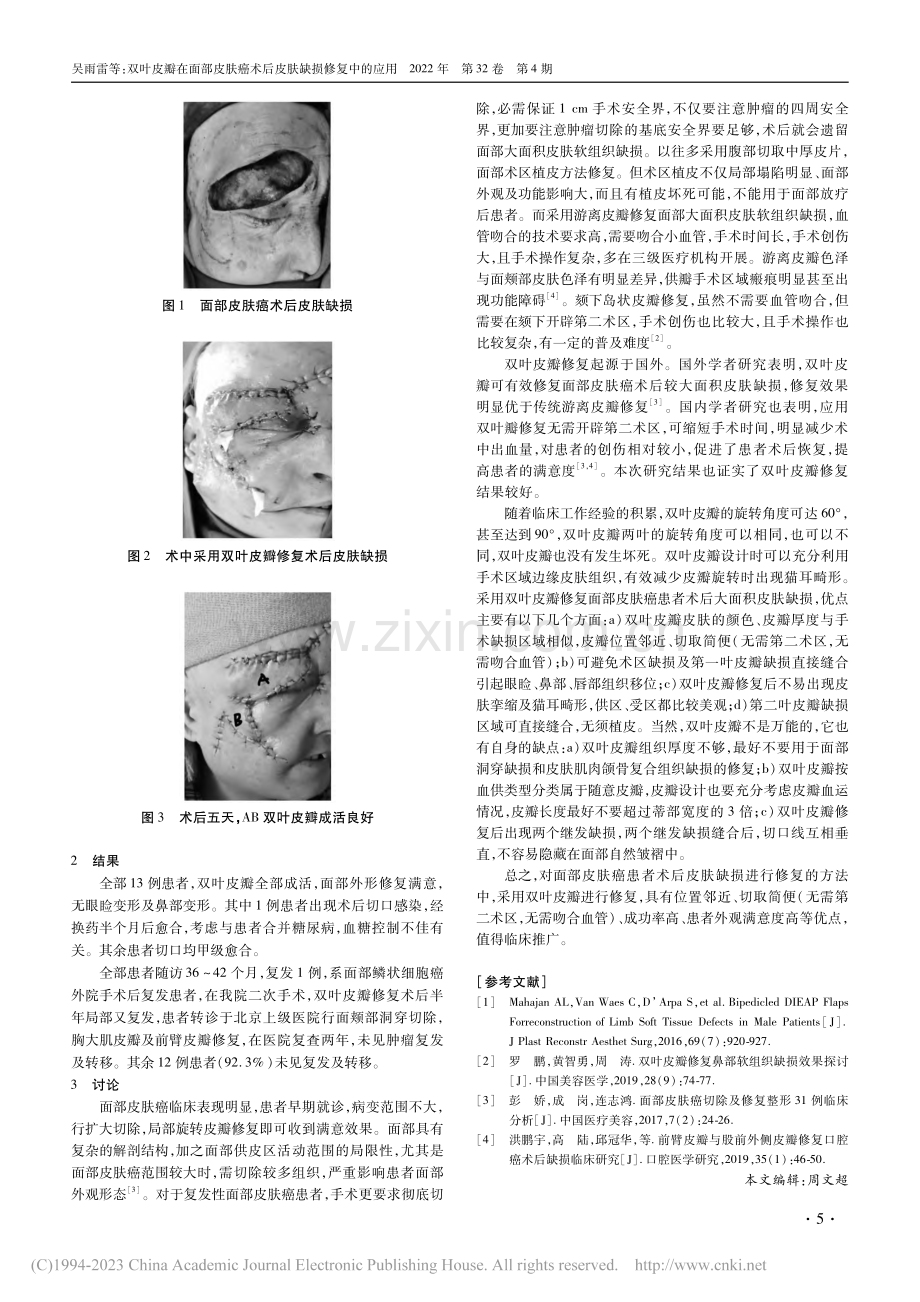 双叶皮瓣在面部皮肤癌术后皮肤缺损修复中的应用_吴雨雷.pdf_第2页