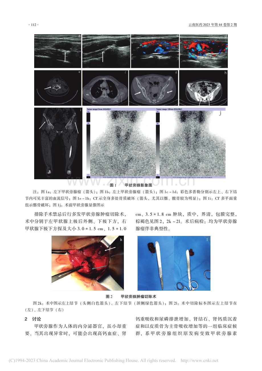 同时并发3颗甲状旁腺腺瘤一例报道_蒋薇薇.pdf_第2页