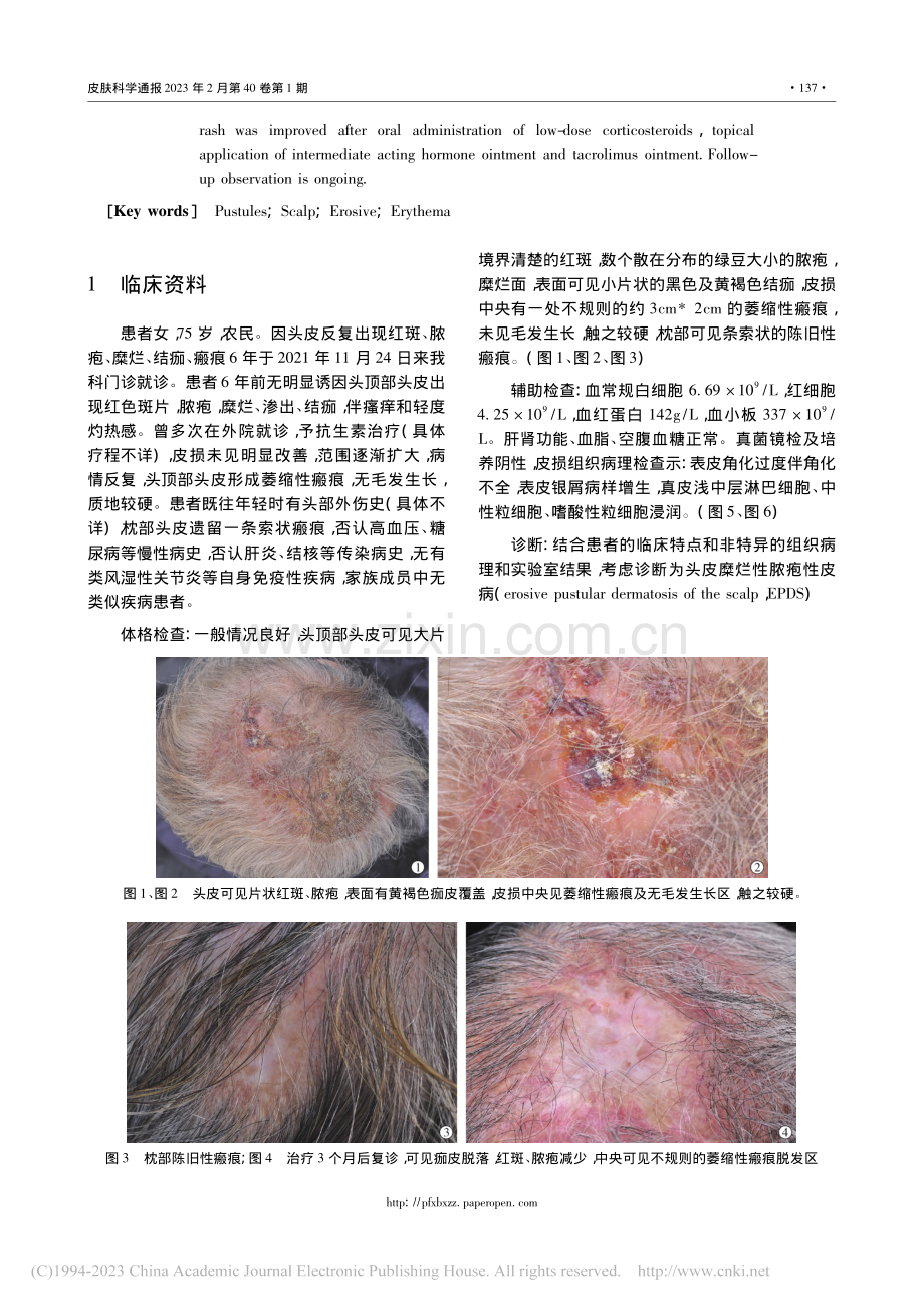 头皮糜烂性脓疱性皮病1例_钟慧琳.pdf_第2页