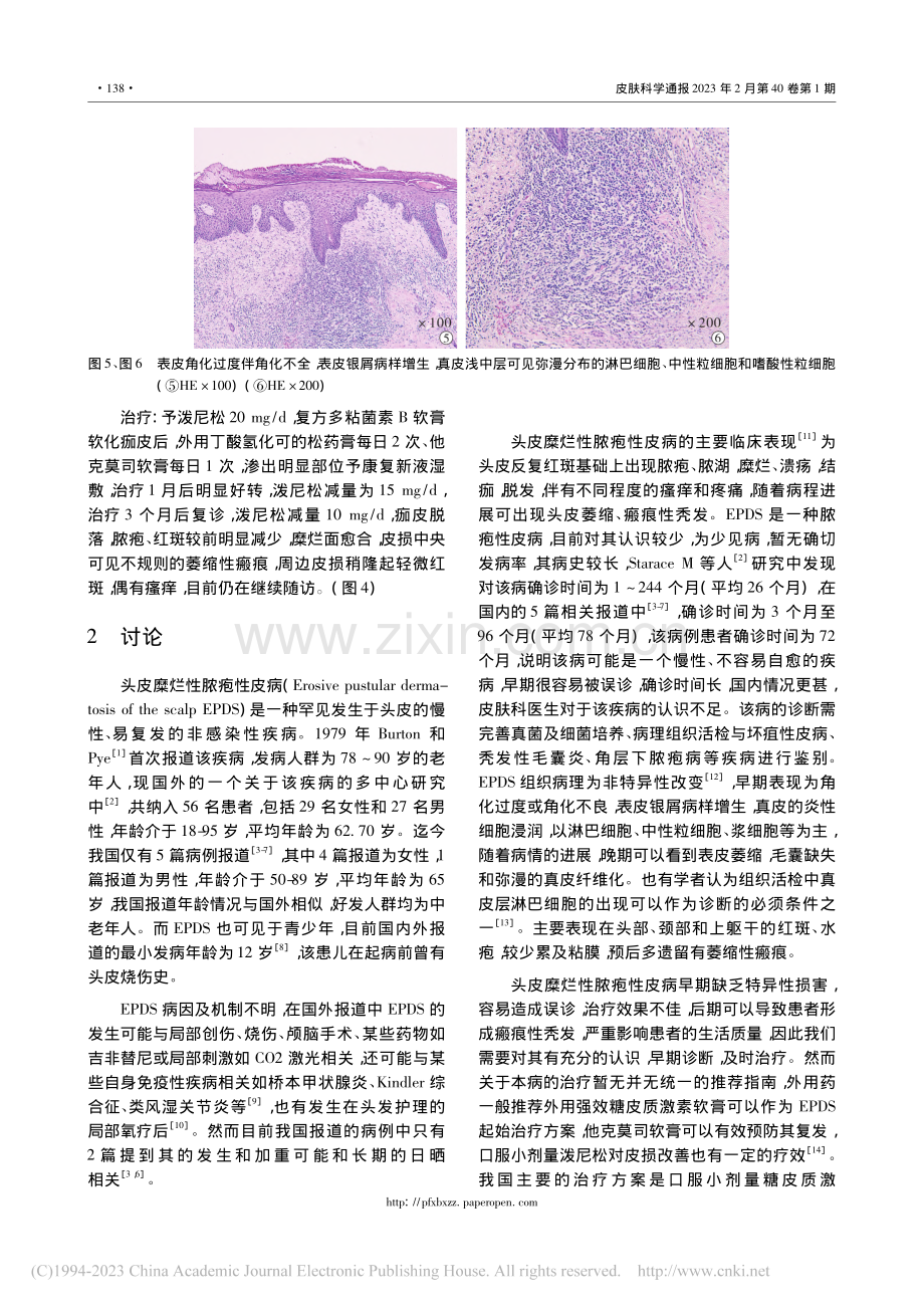头皮糜烂性脓疱性皮病1例_钟慧琳.pdf_第3页