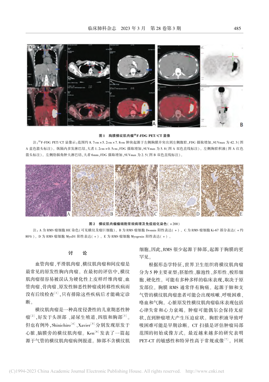 胸膜原发性胚胎性横纹肌肉瘤1例_王芹芹.pdf_第2页