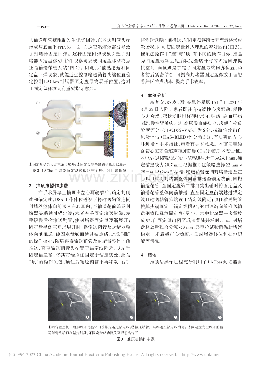 推顶法在LACbes左心耳封堵器植入术中的应用_黎燚华.pdf_第3页