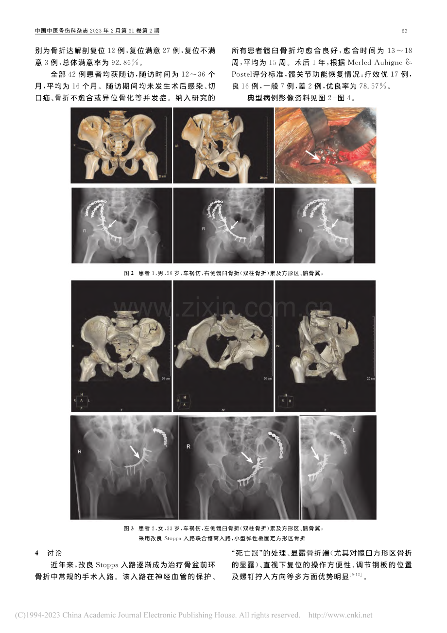 小型弹性板内固定治疗累及方形区的髋臼骨折42例_缪杰佳.pdf_第3页