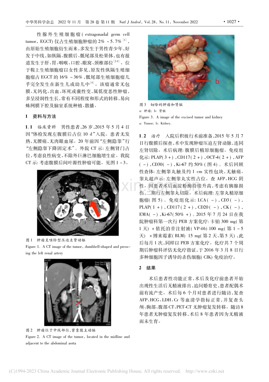 性腺外生殖细胞瘤1例报告并文献复习_李平.pdf_第2页
