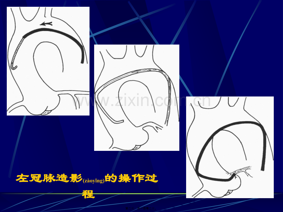 爱爱医资源-冠脉造影术简装板-绝好资料.ppt_第2页