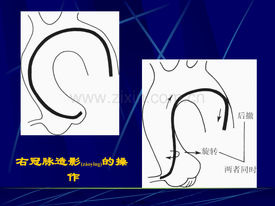 爱爱医资源-冠脉造影术简装板-绝好资料.ppt_第3页