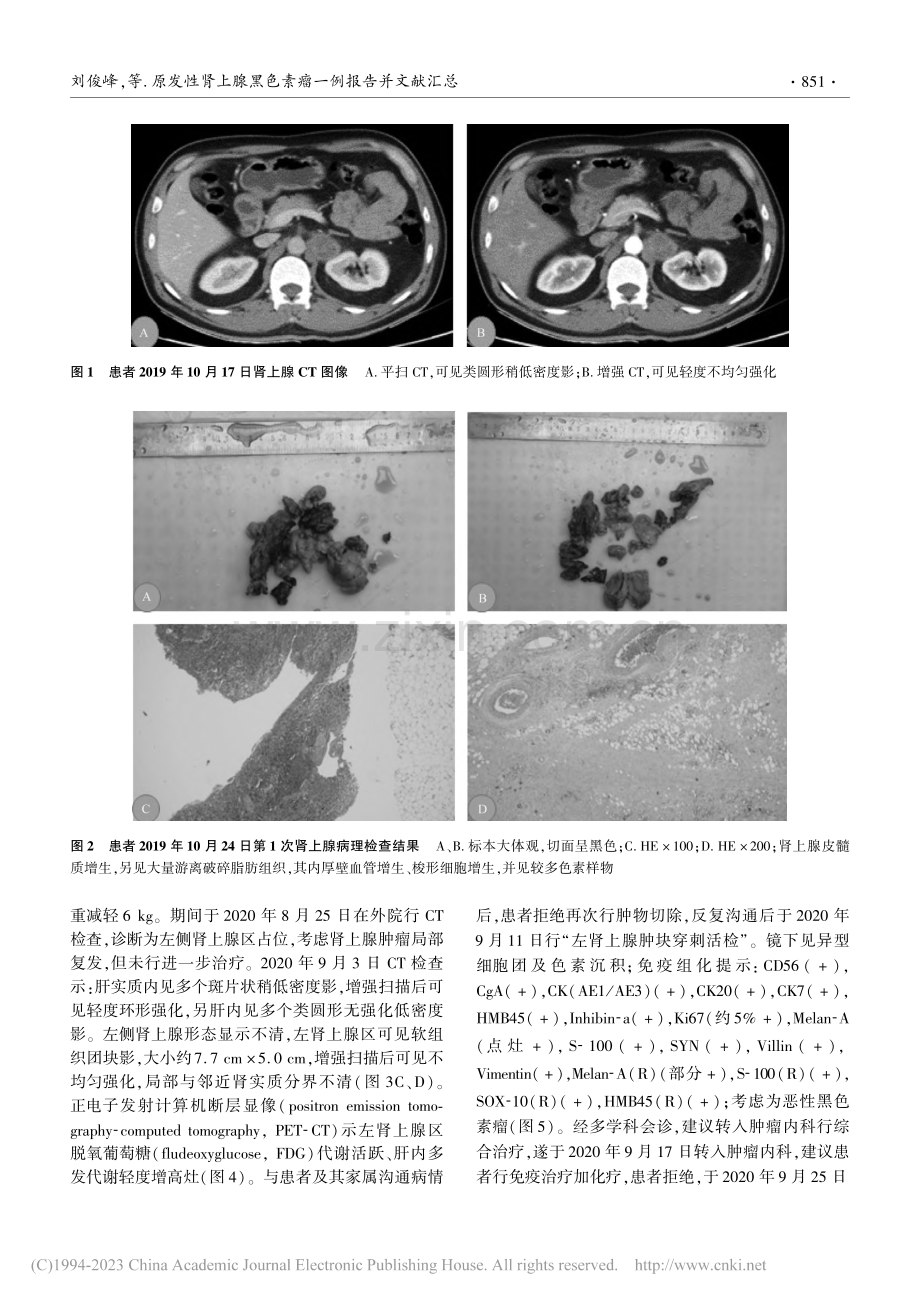 原发性肾上腺黑色素瘤一例报告并文献汇总_刘俊峰.pdf_第2页