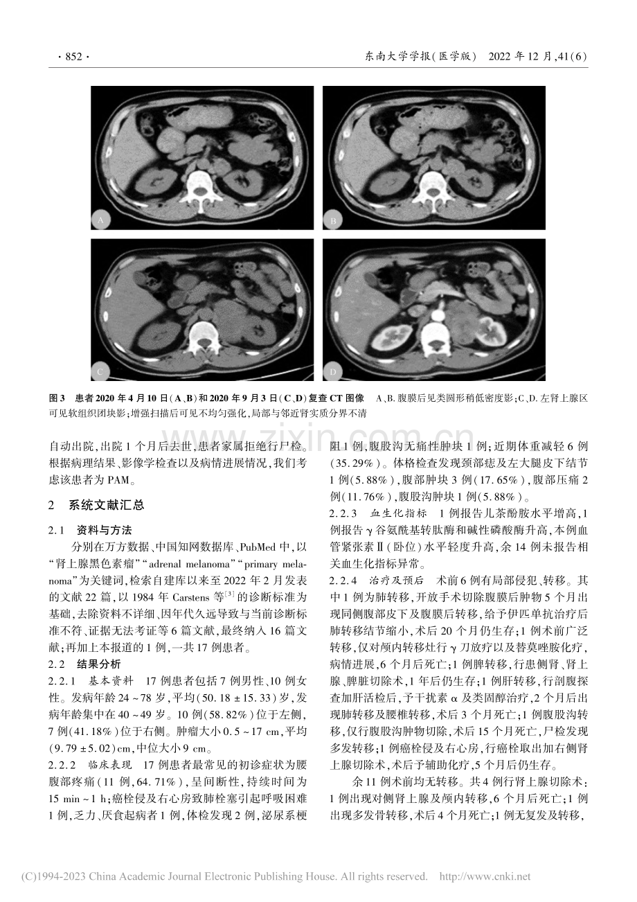 原发性肾上腺黑色素瘤一例报告并文献汇总_刘俊峰.pdf_第3页