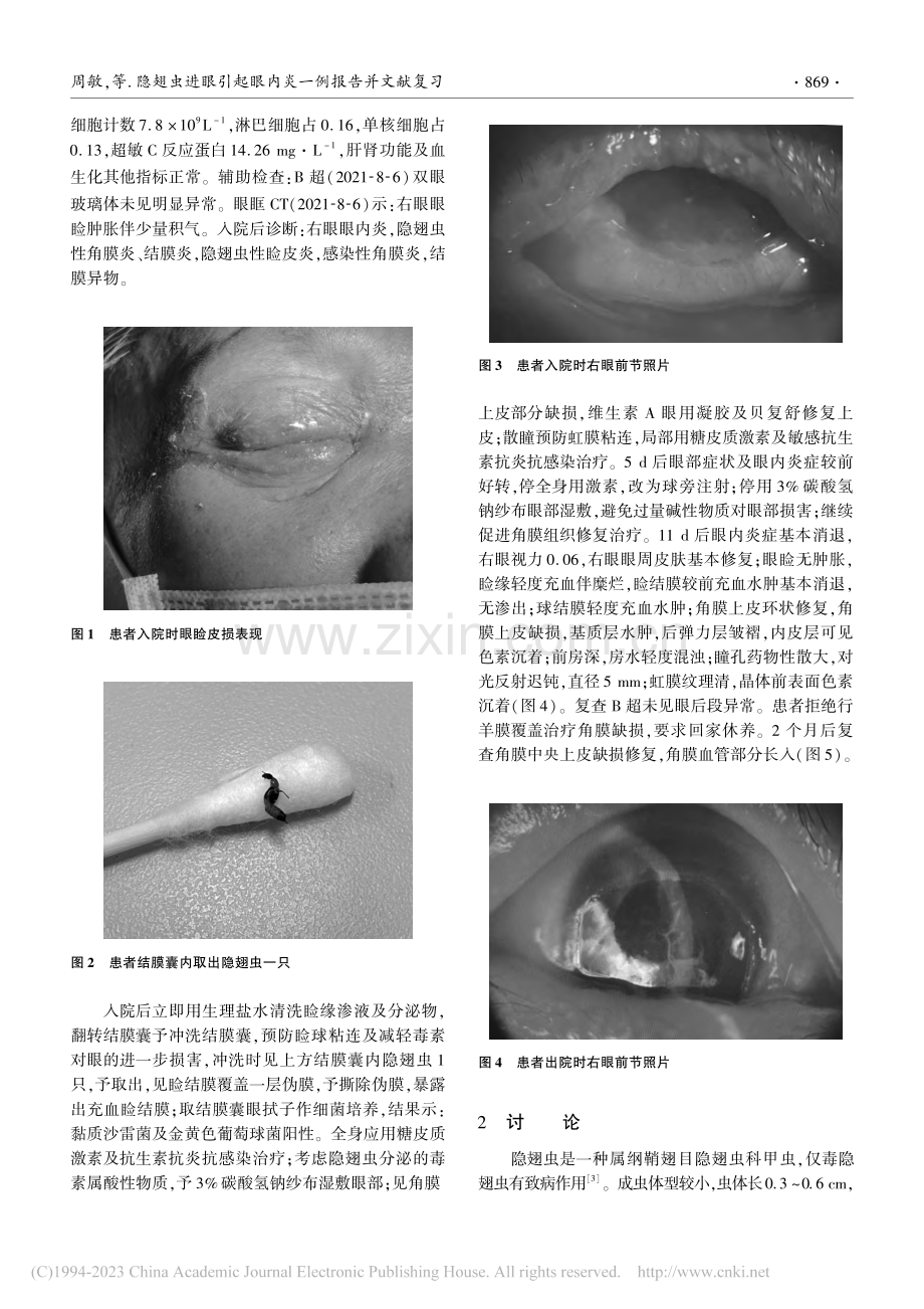 隐翅虫进眼引起眼内炎一例报告并文献复习_周敏.pdf_第2页