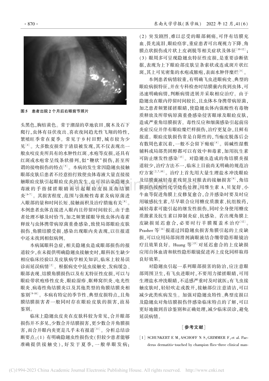 隐翅虫进眼引起眼内炎一例报告并文献复习_周敏.pdf_第3页