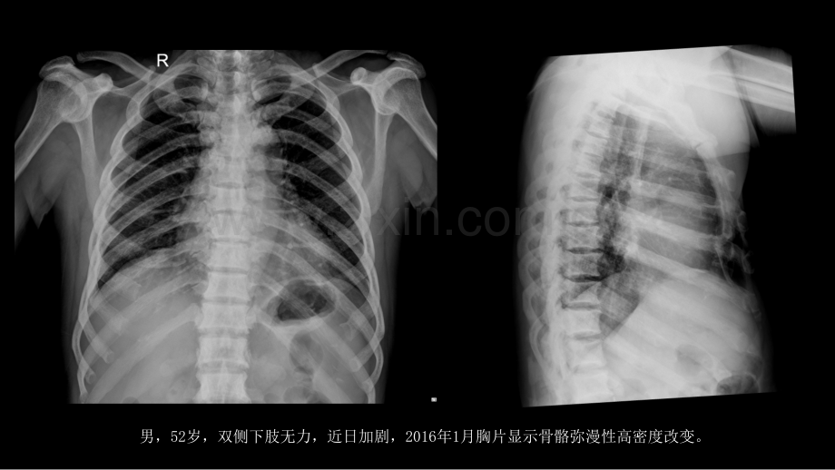 氟骨症的X线CT及MR影像及解读.pptx_第2页