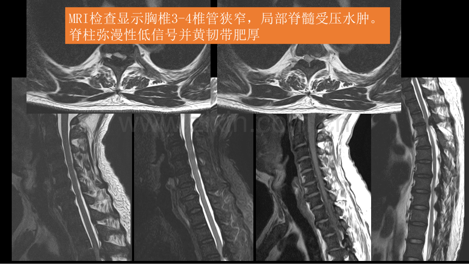 氟骨症的X线CT及MR影像及解读.pptx_第3页