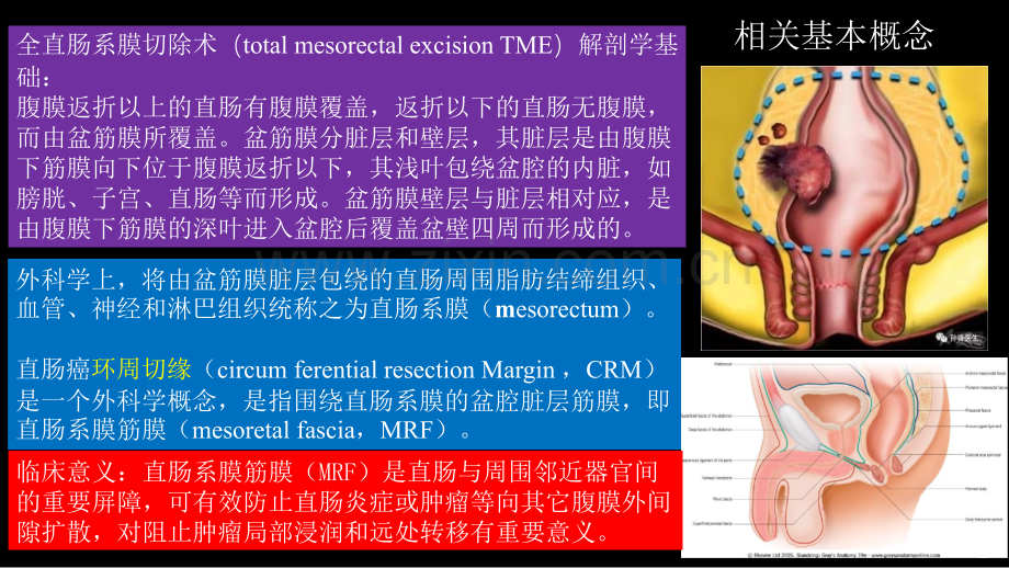 直肠癌：MRI与临床.pptx_第3页