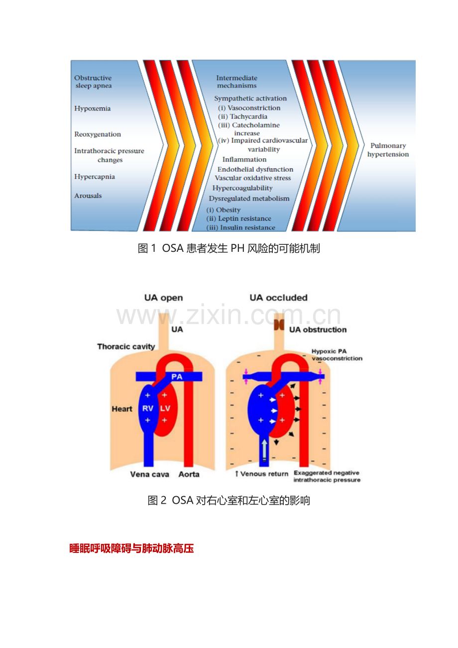 柳志红教授：实例解析阻塞性睡眠呼吸暂停与肺动脉高压.docx_第2页