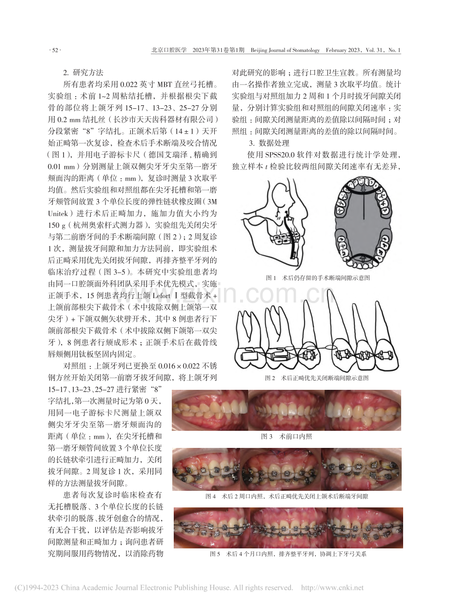 手术优先模式下术后正畸关闭拔牙间隙的初步研究_赵梓琴.pdf_第2页