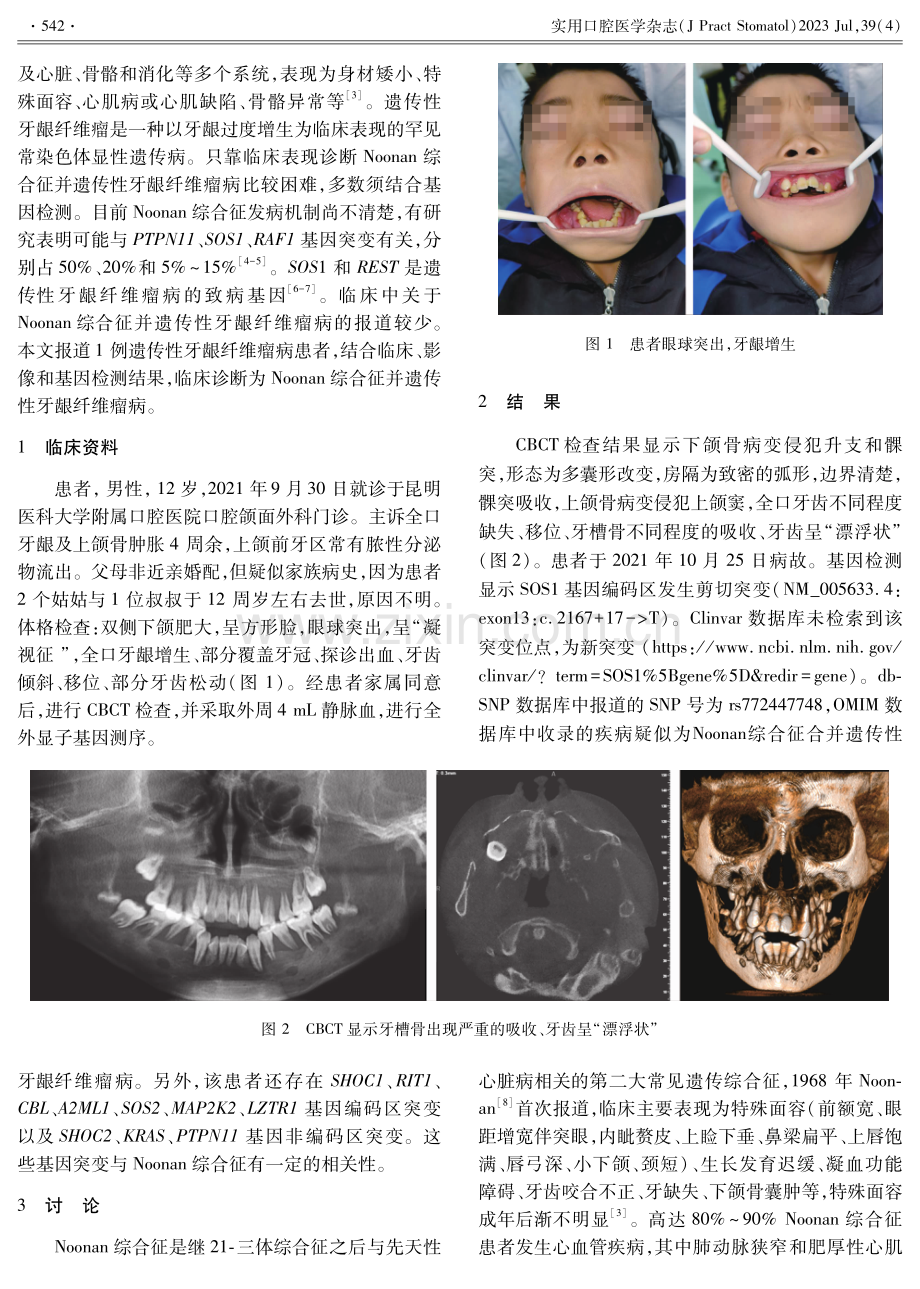 Noonan综合征病合并遗传性牙龈纤维瘤病1例.pdf_第2页