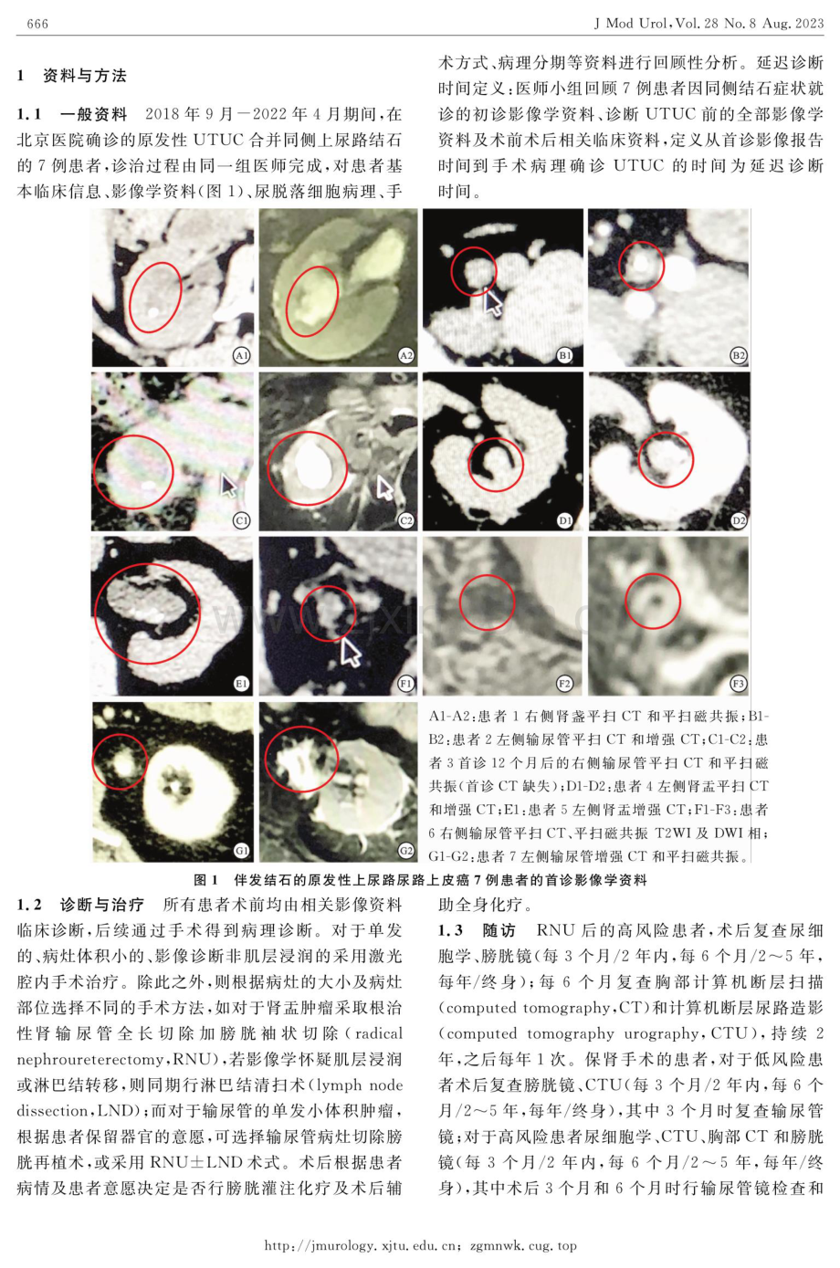 伴发结石的原发性上尿路尿路上皮癌患者延迟诊断7例分析.pdf_第2页