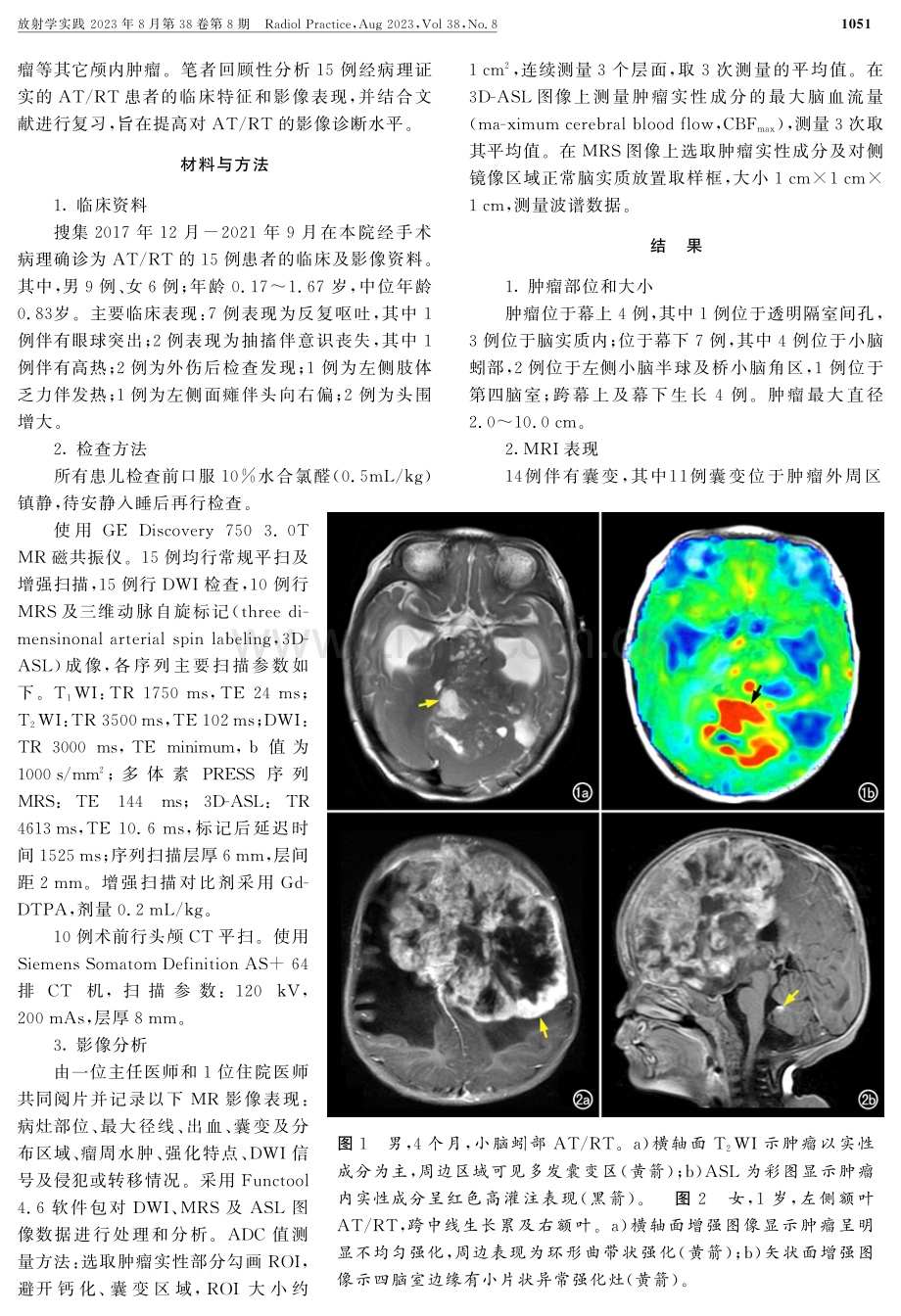 儿童颅内非典型畸胎瘤样_横纹肌样瘤的影像表现.pdf_第2页