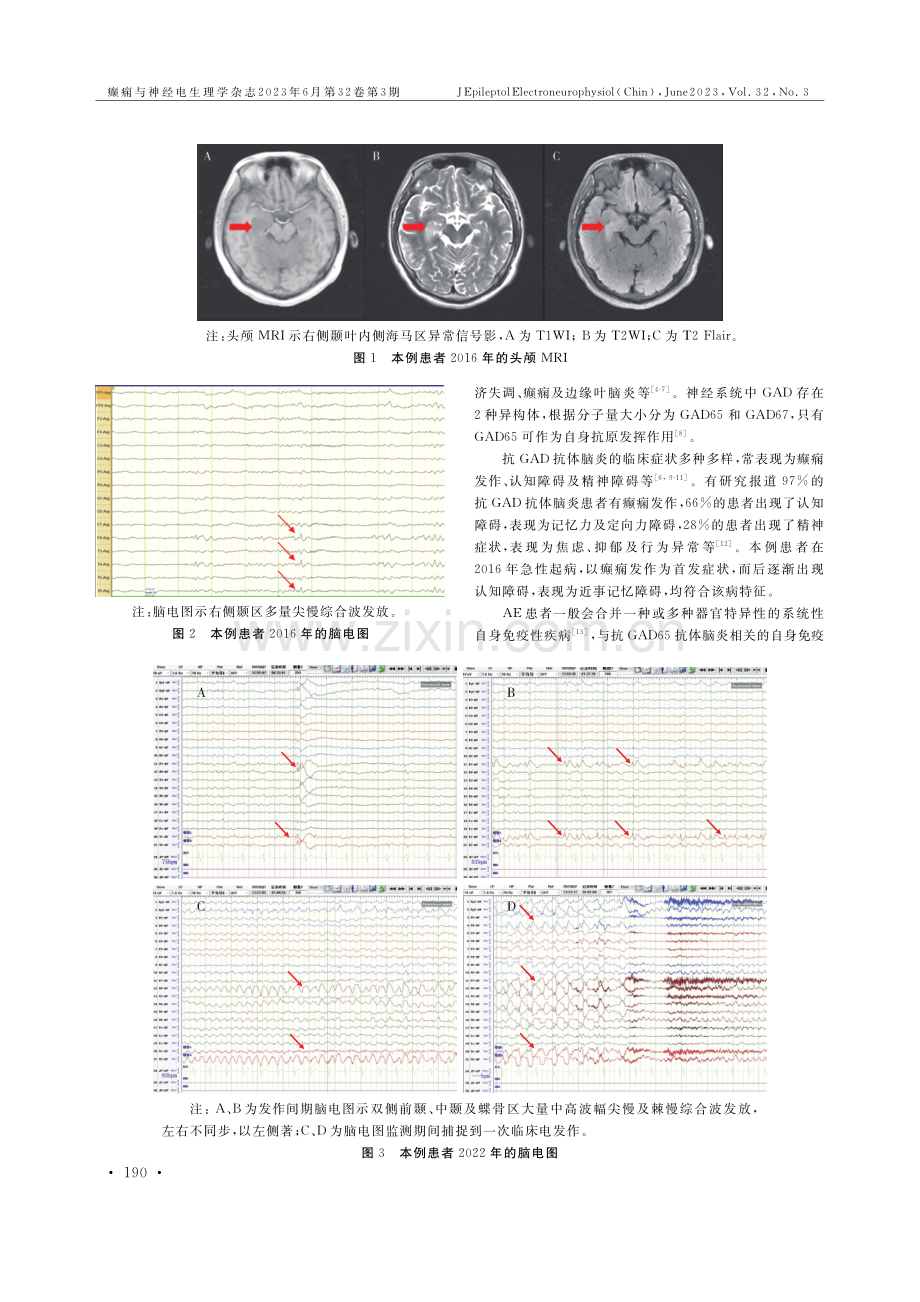 抗谷氨酸脱羧酶65抗体脑炎1例报告.pdf_第2页