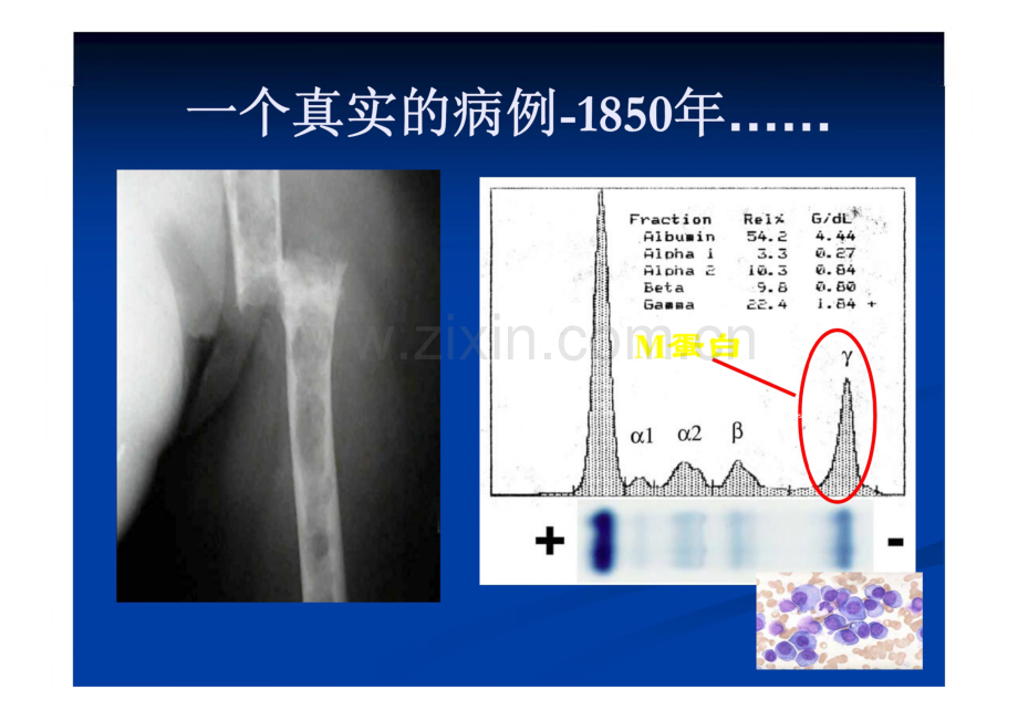 多发性骨髓瘤早期诊断和治疗.pdf_第3页