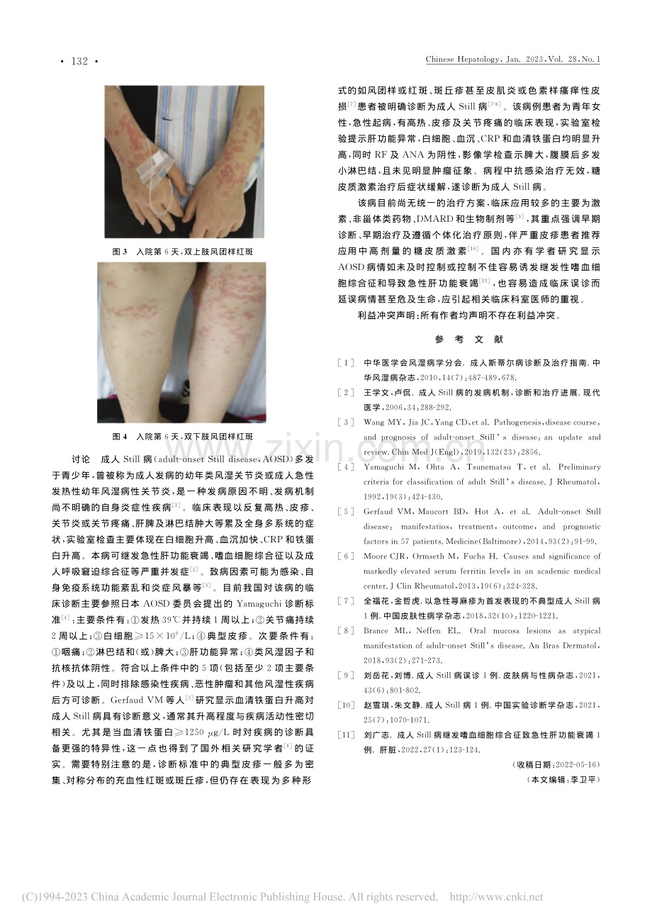 成人Still病合并肝功能衰竭前期误诊1例_王丽惠.pdf_第2页