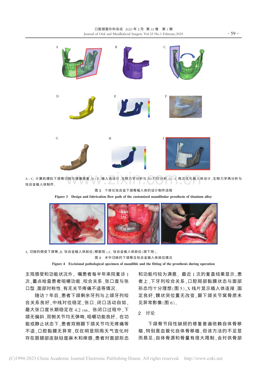 3D打印钛合金植入体下颌骨修复重建远期效果观察1例_张庆福.pdf_第3页