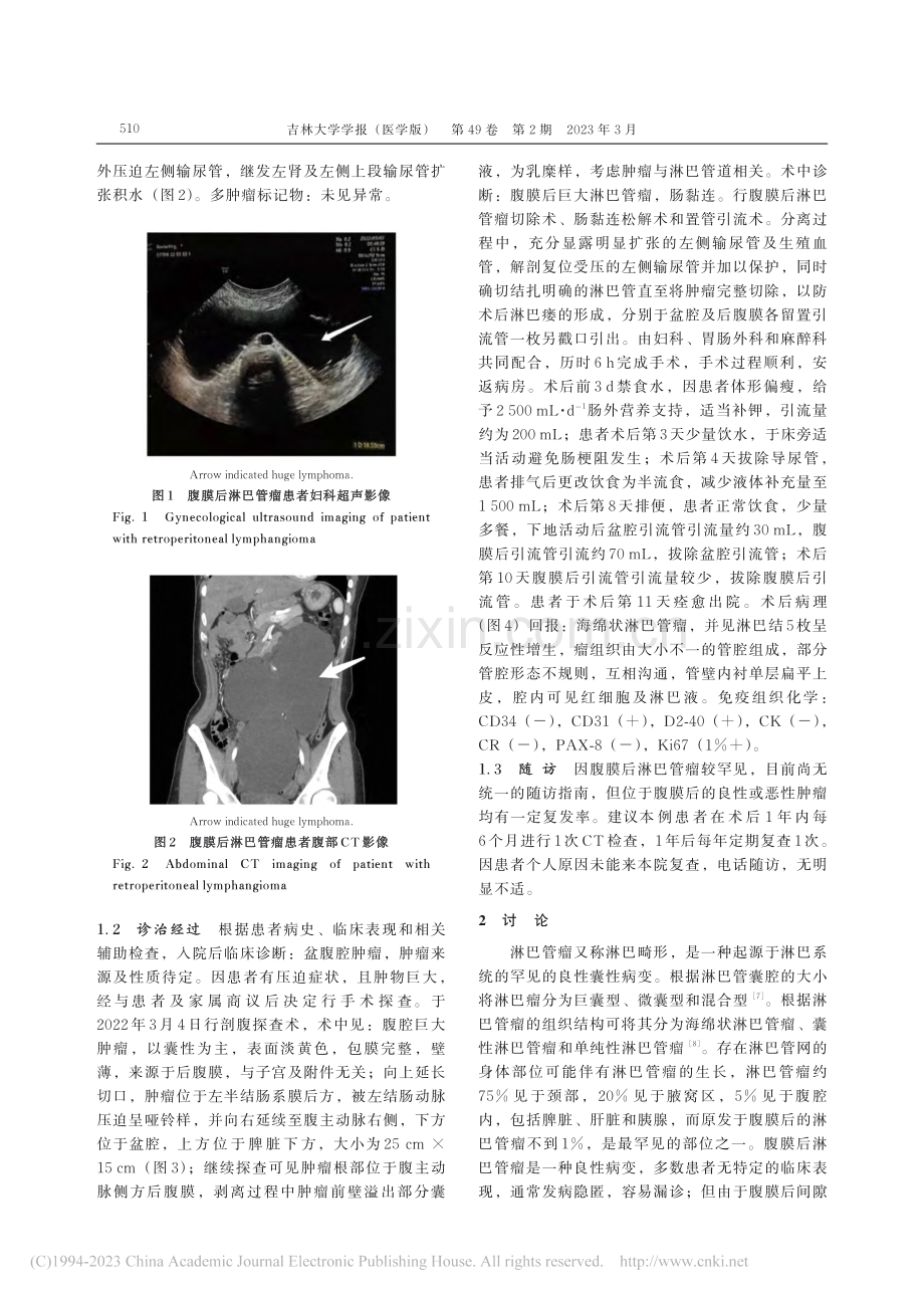 腹膜后巨大淋巴管瘤1例报告及文献复习_杨胜男.pdf_第3页