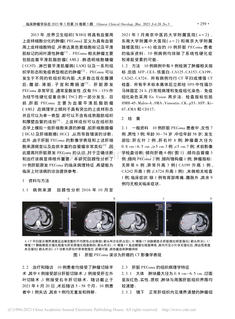 肝脏血管周上皮样细胞肿瘤的临床病理观察_赵苏苏.pdf_第2页