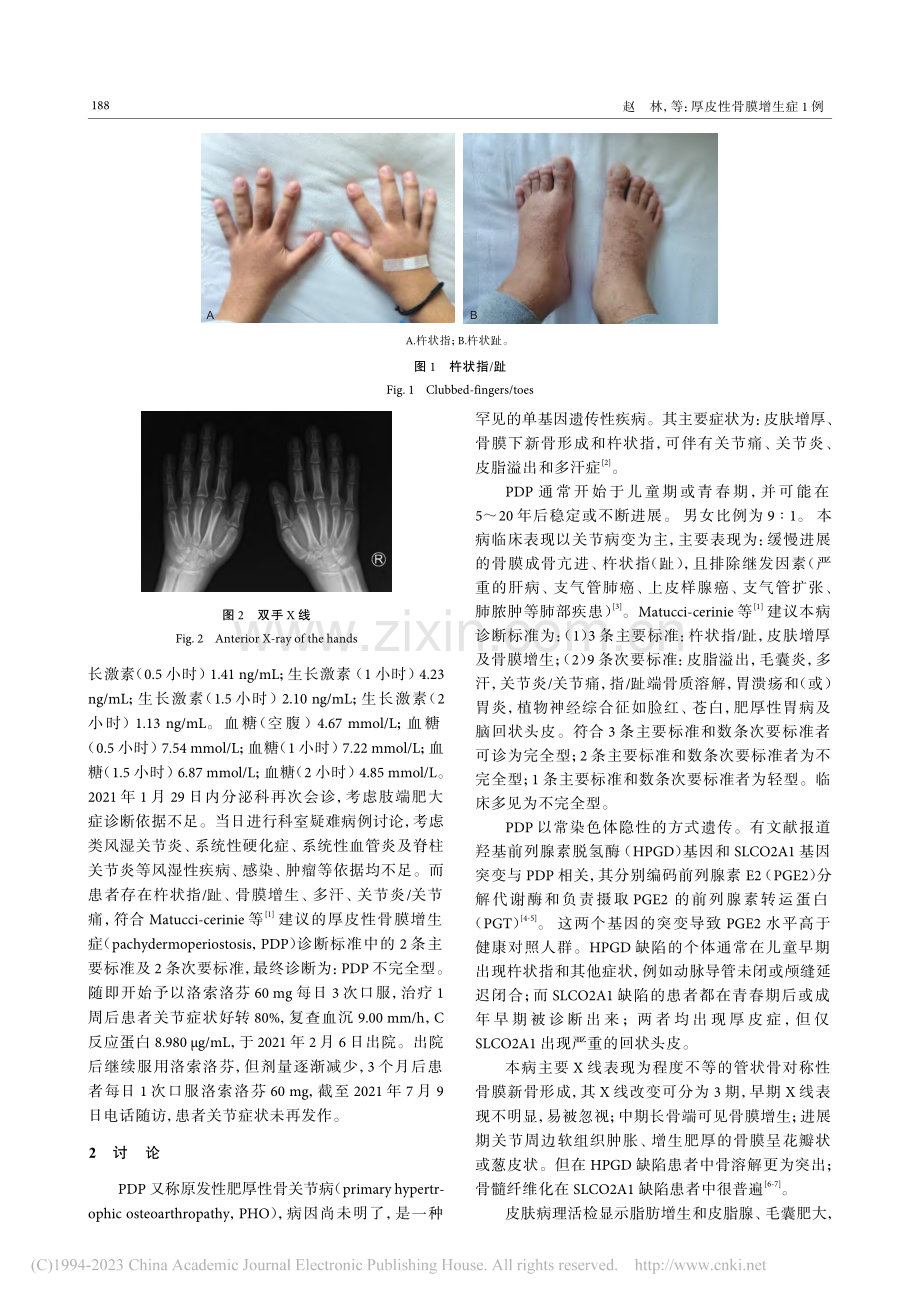 厚皮性骨膜增生症1例_赵林.pdf_第2页
