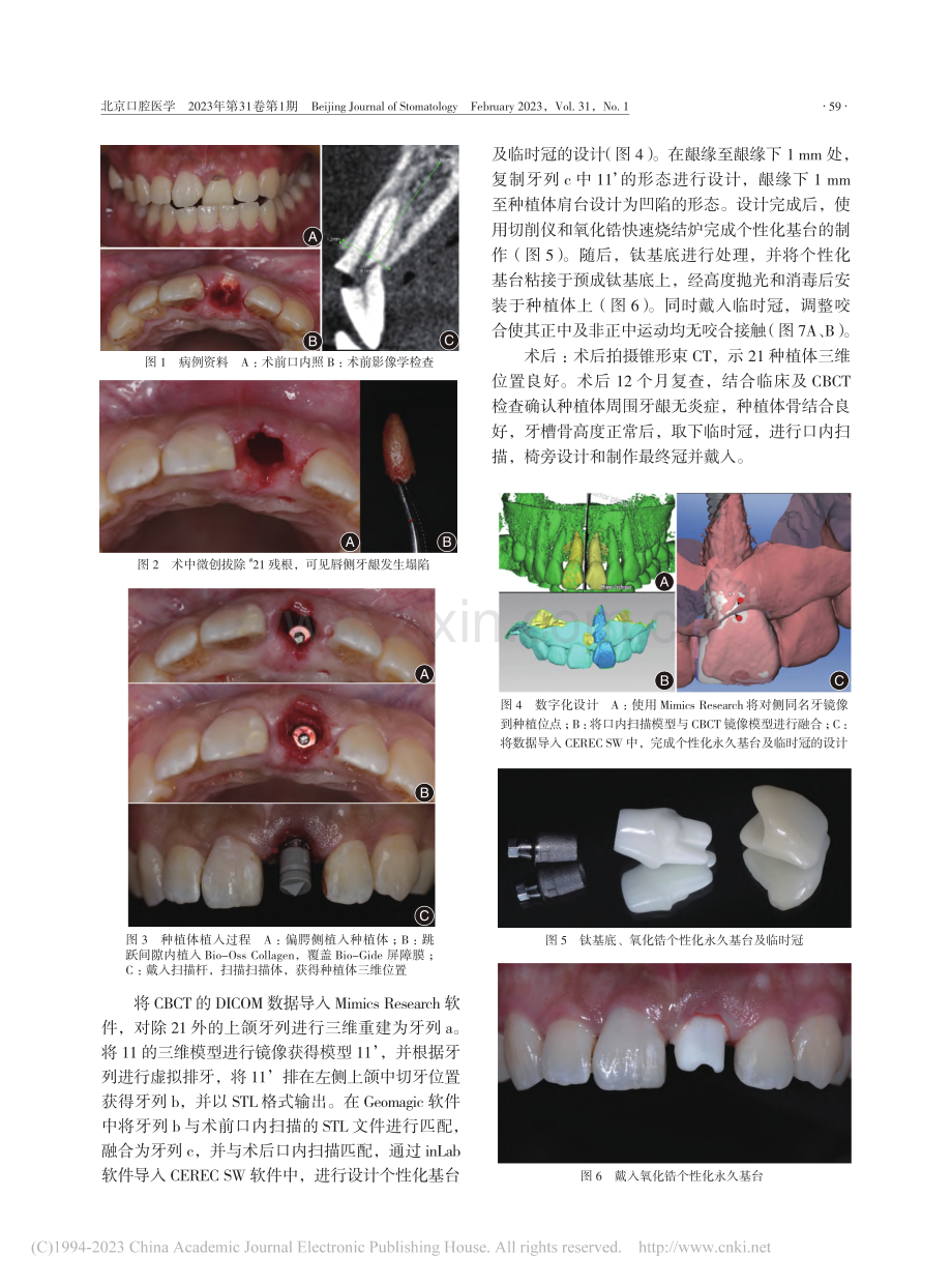 镜像技术在前牙美学区即刻种...刻修复中的应用-附1例报道_袁鼎翔.pdf_第2页