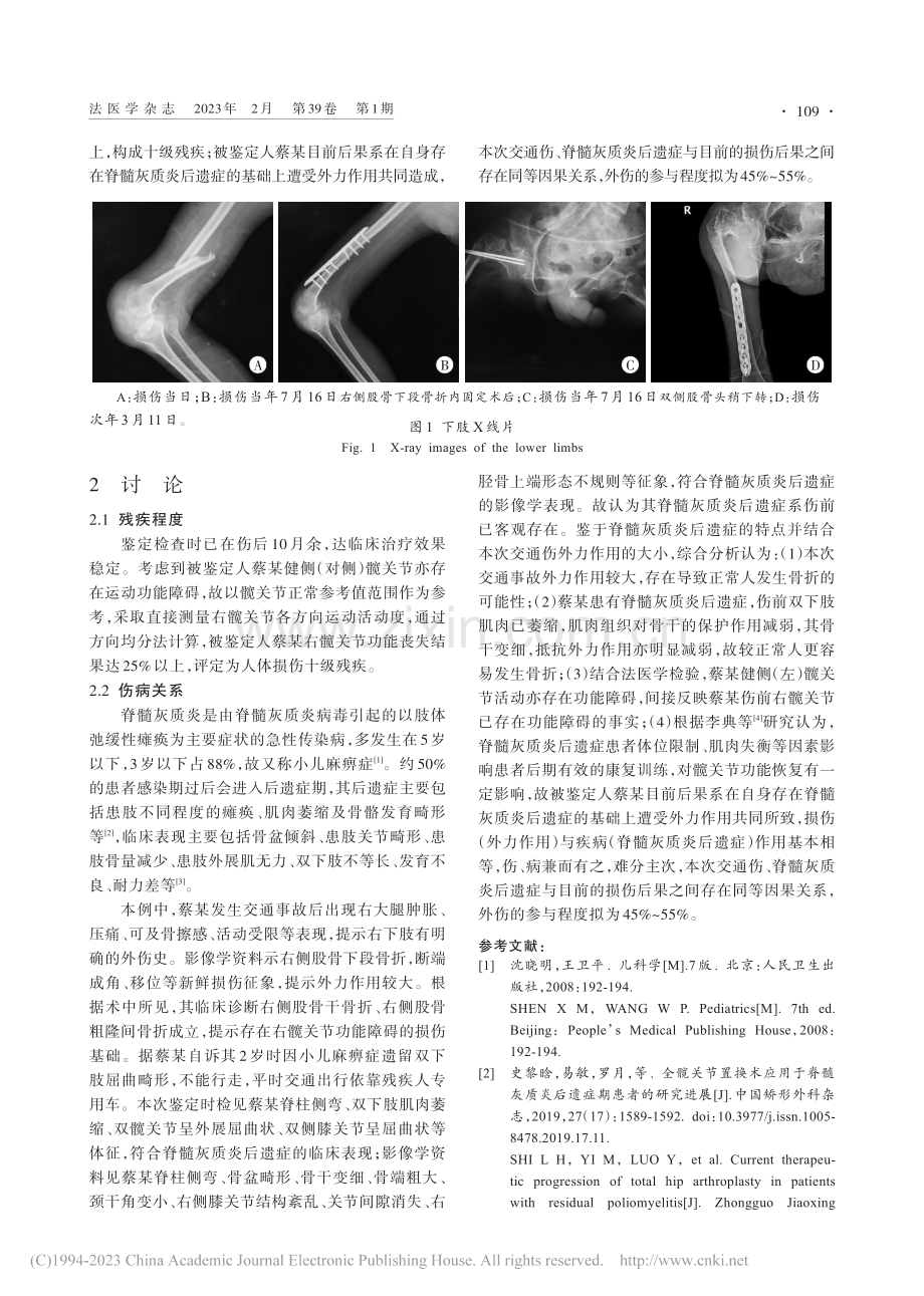 脊髓灰质炎后遗症患者下肢骨折法医学鉴定1例_丁劲峰.pdf_第2页