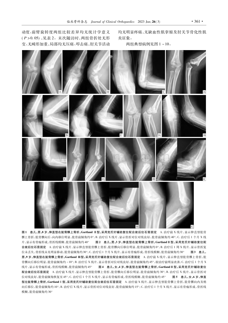 两种闭合复位固定方法治疗儿童肱骨髁上骨折的疗效比较_吴奇峰.pdf_第3页