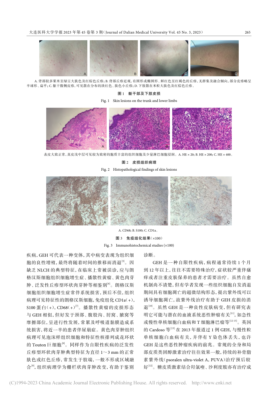 泛发性发疹性组织细胞瘤1例_王一帆.pdf_第2页