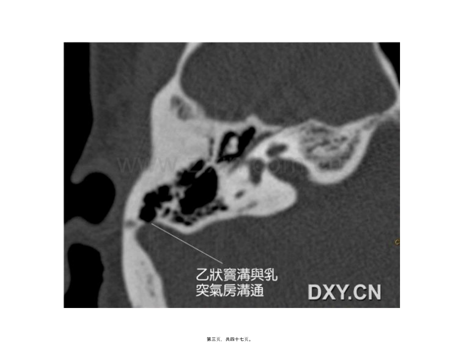 学术讨论—耳鸣与乙状窦憩室...ppt_第3页