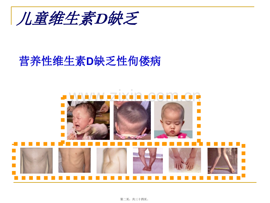 儿童维生素D缺乏.ppt_第2页