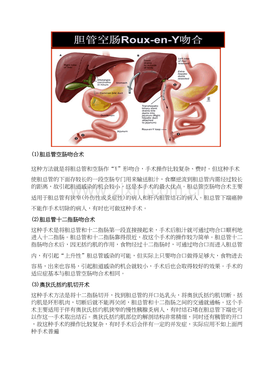 胆肠吻合术.docx_第1页