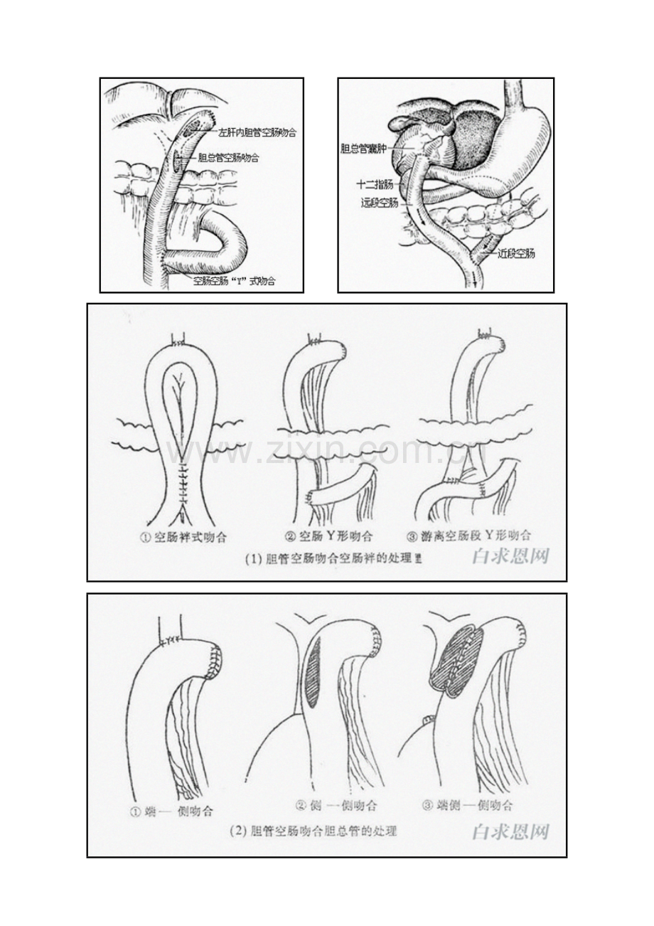 胆肠吻合术.docx_第2页