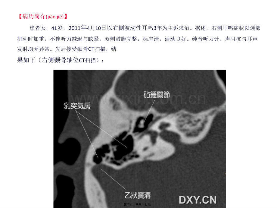 耳鸣与乙状窦憩室.ppt_第2页