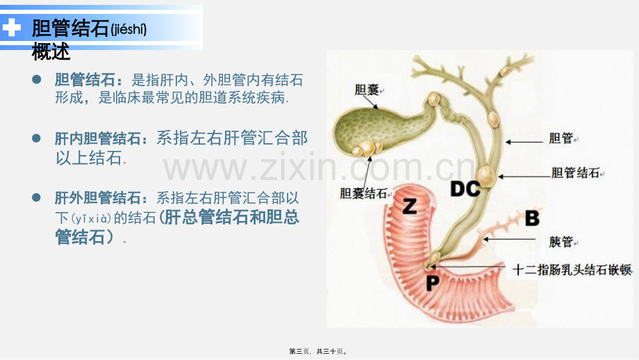 胆管结石.ppt_第3页