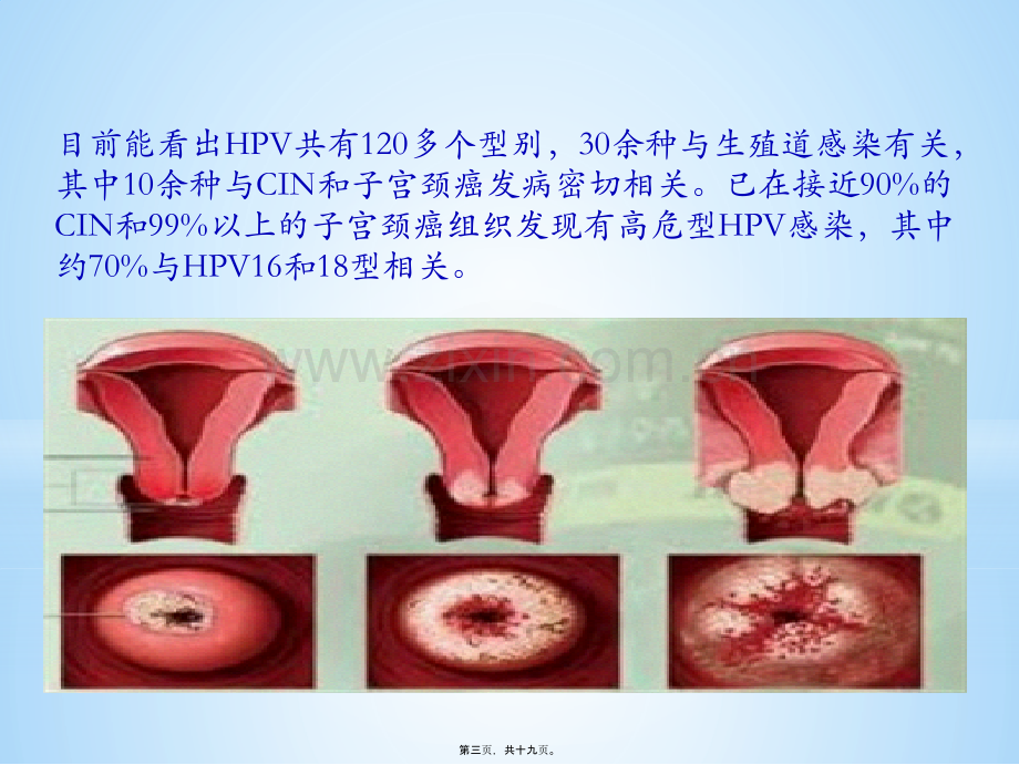 宫颈癌疫苗与HPV.ppt_第3页