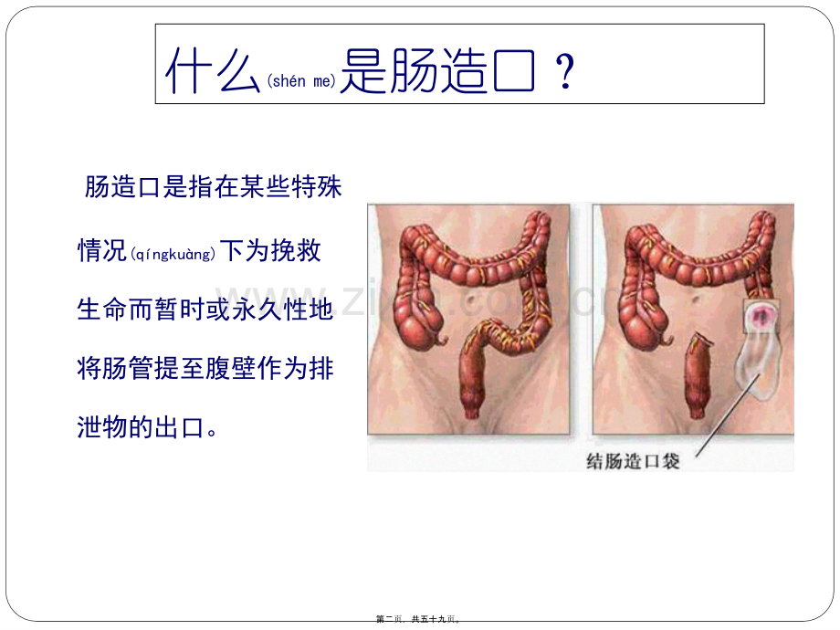 肠造口术.ppt_第2页