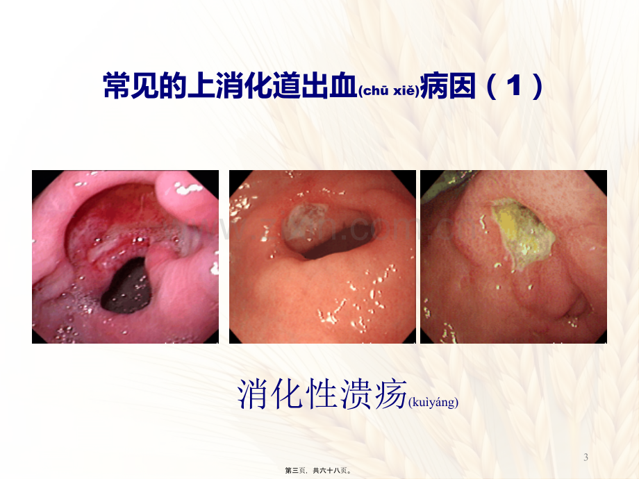 上消化道出血的诊治思维.ppt_第3页