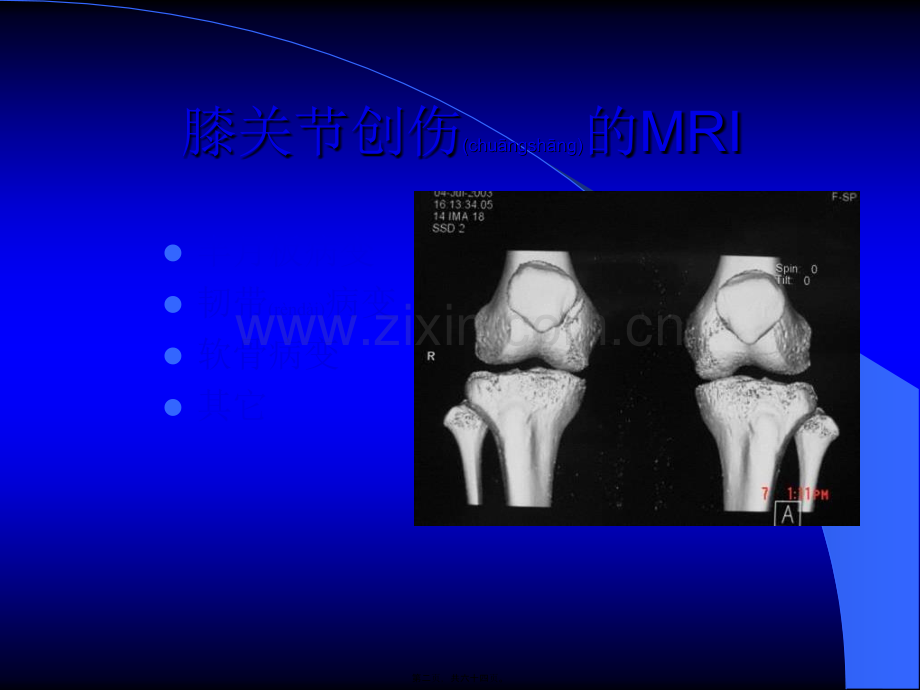 MRI膝关节.ppt_第2页