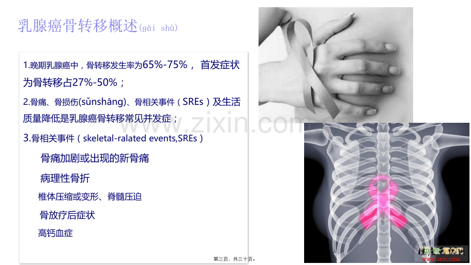 乳腺癌骨转移.pptx_第3页