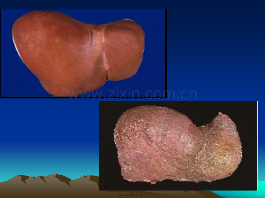 肝硬化(Cirrhosis-of-the-liver).ppt_第2页