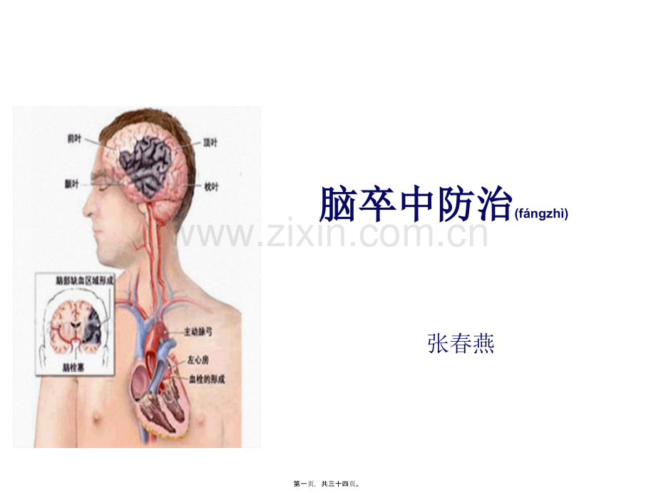 学术讨论—脑卒中防治.ppt_第1页